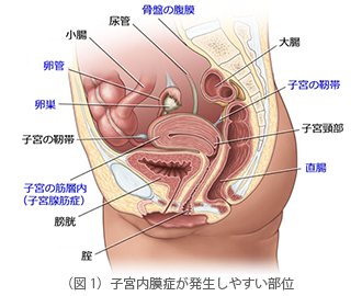銀座レディースクリニック　子宮内膜症